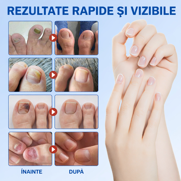 Rezultate vizibile pe unghii sănătoase.png